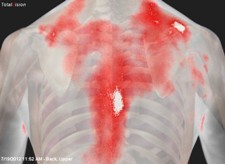 Medical Thermography Inflammation Back